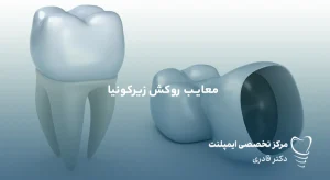 معایب روکش زیرکونیا