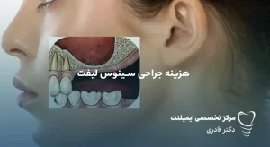 مقالات 30 هزینه جراحی سینوس لیفت