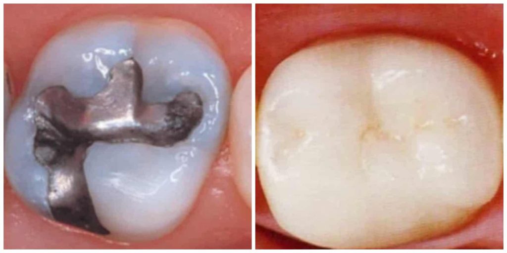 silver vs resin filling 1024x512 1
