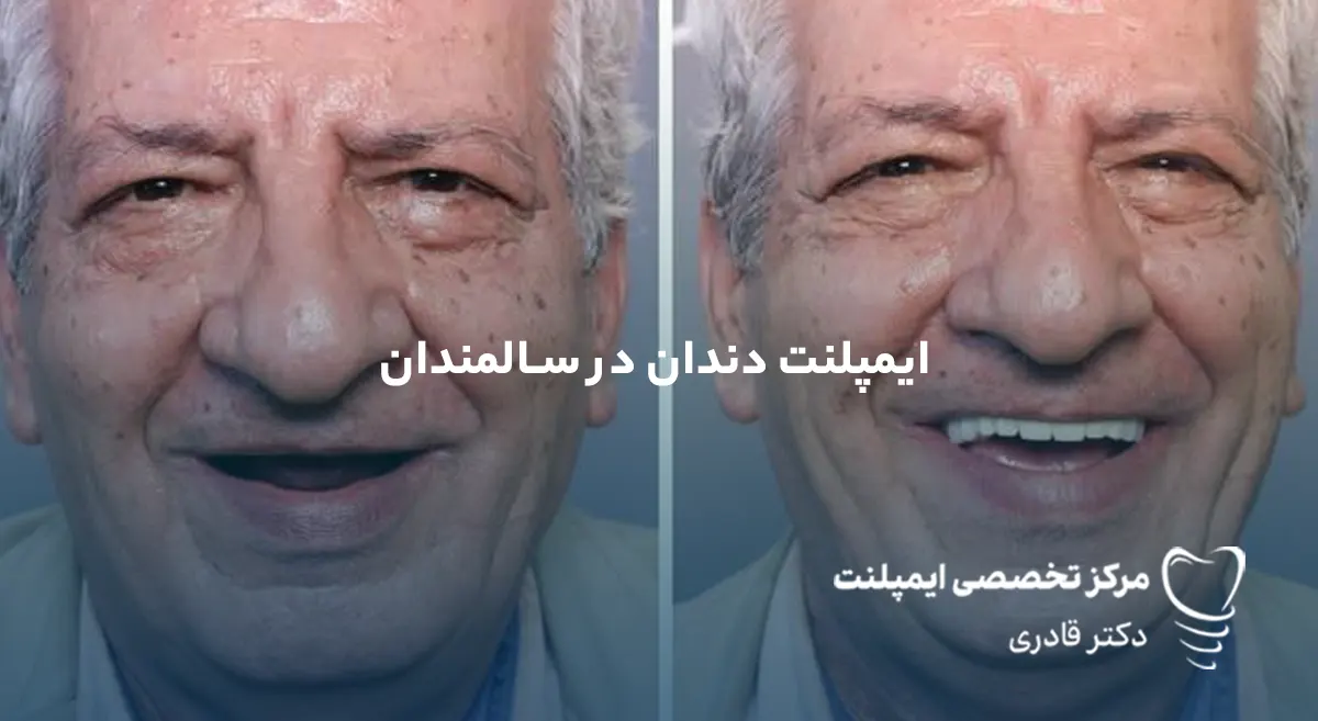 ایمپلنت دندان برای سالمندان