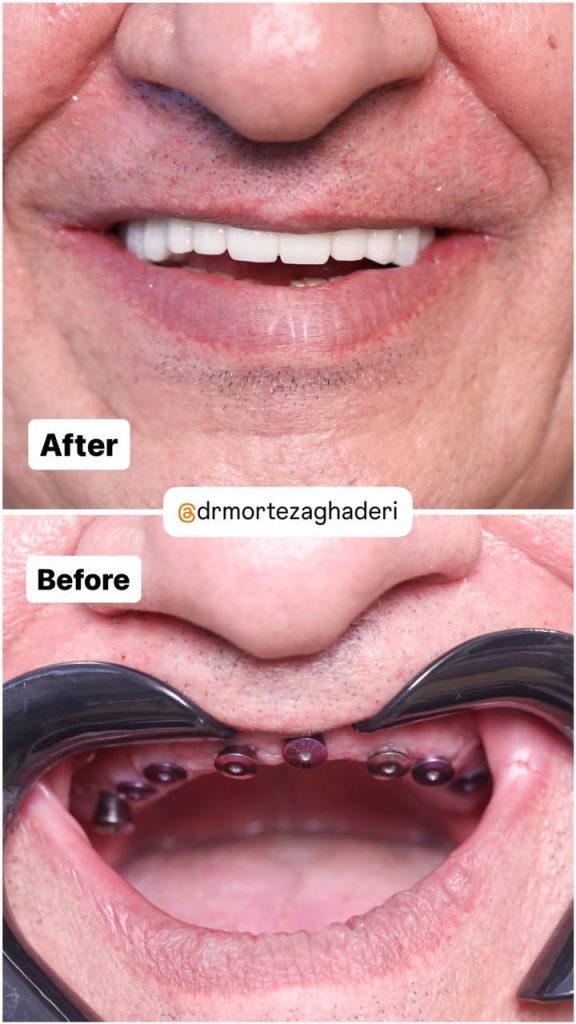 ایمپلنت سالمندان