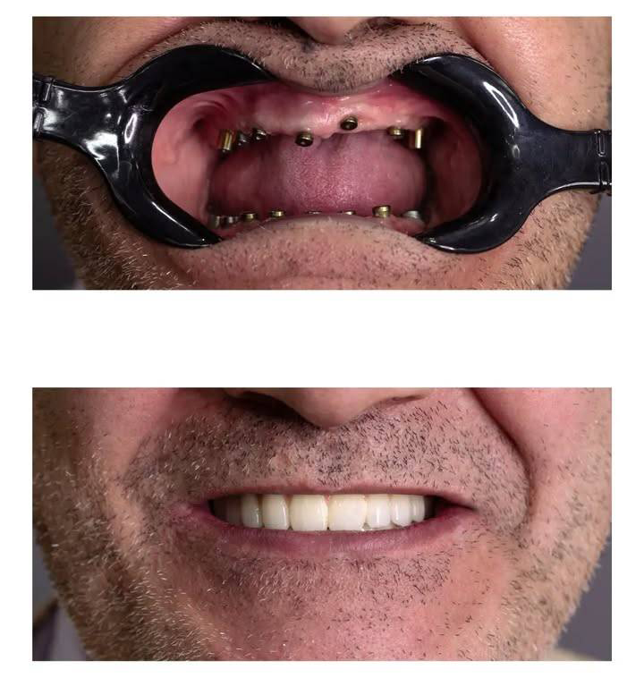 ایمپلنت برای سالمندان