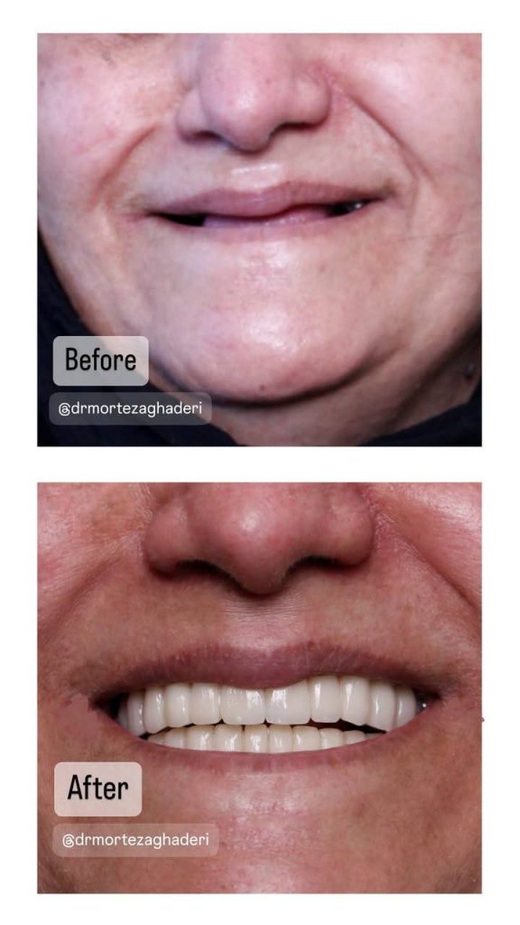 ایمپلنت دندان برای سالمندان