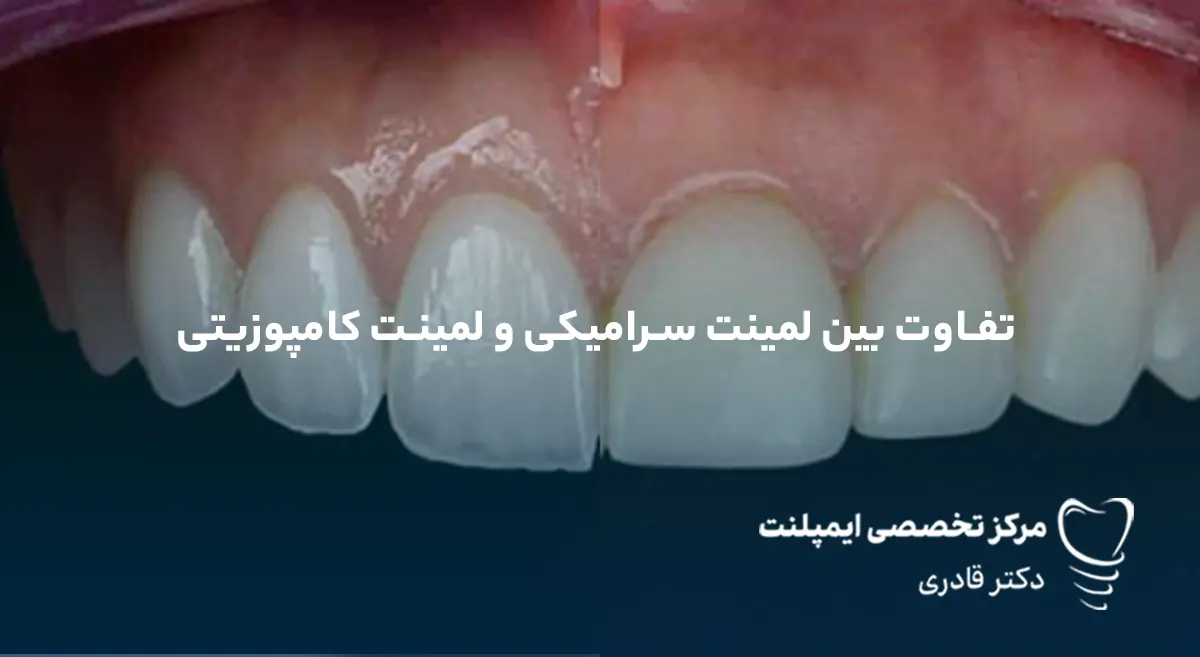 تفاوت بین لمینت سرامیکی و لمینت کامپوزیتی