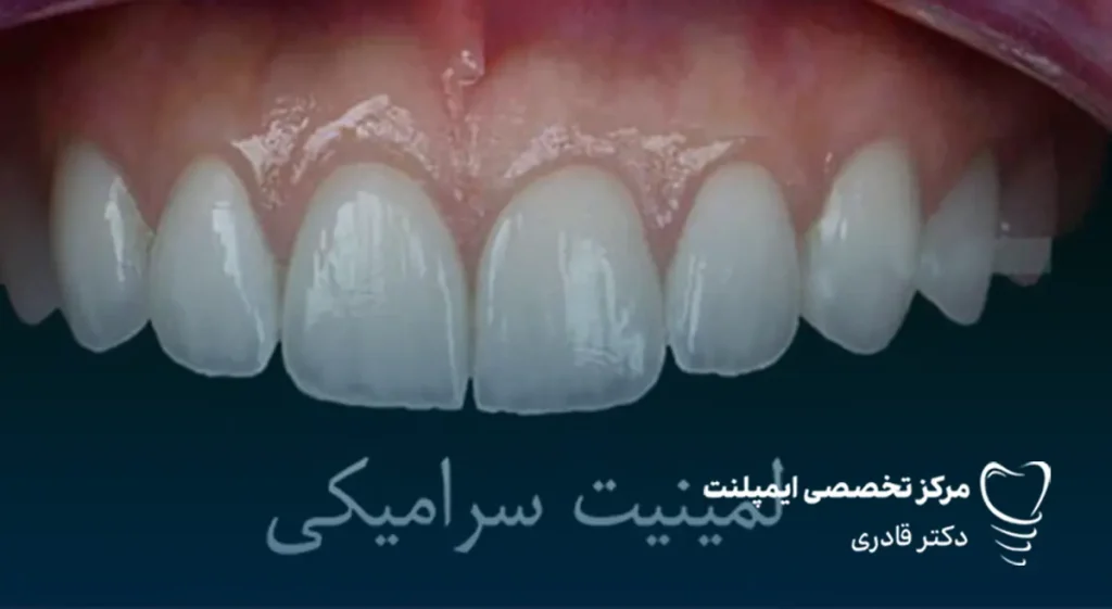 تفاوت بین لمینت سرامیکی و لمینت کامپوزیتی همه ما می‌دانیم که یکی از مهم‌ترین عوامل تاثیرگذار بر اعتماد به نفس افراد لبخند است و همه دوست دارند لبخندی زیبا داشته باشند. لمینت سرامیکی و کامپوزیتی دو گزینه محبوب برای دستیابی به لبخندی درخشان و بی‌نقص هستند. هر یک از این روش‌ها مزایا و کاربردهای خاص خود را دارند و انتخاب بین آن‌ها به عوامل مختلفی از جمله وضعیت دندان‌ها، بودجه و سلیقه فردی بستگی دارد. در این مقاله، به تفاوت بین لمینت سرامیکی و لمینت کامپوزیتی پرداخته و به شما کمک می‌کنیم تا بهترین تصمیم را برای داشتن لبخندی زیبا بگیرید. لمنیت سرامیکی چیست و چه مزایایی دارد؟ قبل از بررسی تفاوت بین لمینت سرامیکی و لمینت کامپوزیتی بهتر است هر کدام را به صورت جداگانه معرفی کنیم. لمینت سرامیکی یک پوشش نازک و ظریف از جنس سرامیک است که به سطح جلویی دندان‌ها چسبانده می‌شود تا ظاهر دندان‌ها زیباتر و مرتب‌تر به نظر برسد. این روکش معمولاً برای اصلاح مشکلاتی مثل تغییر رنگ دندان‌ها، ترک‌ها، شکستن‌های جزئی یا فاصله‌های بین دندان‌ها استفاده می‌شود. برای نصب لمینت سرامیکی، دندان‌ها به طور کمی تراشیده می‌شوند تا روکش به درستی روی دندان‌ها قرار بگیرد. این روش به دلیل استفاده از سرامیک، به دندان‌ها ظاهری طبیعی و مقاوم می‌دهد. مزایای لمینت سرامیکی: • ظاهر طبیعی و زیبا: به دلیل شفافیت و همرنگ بودن با دندان‌های طبیعی، ظاهر زیباتری نسبت به سایر روش‌ها دارد. • مقاومت بالا: لمینت سرامیکی بسیار مقاوم است و در برابر لکه‌ها و آسیب‌های خارجی مقاومت بیشتری دارد. • طول عمر طولانی: این نوع لمینت به طور معمول بیشتر از کامپوزیت‌ها عمر می‌کند. • اصلاح سریع مشکلات دندانی: می‌تواند به سرعت مشکلاتی مانند تغییر رنگ، ترک‌ها و بی‌نظمی‌های جزئی دندان‌ها را برطرف کند. • حساسیت کمتر: به دلیل تراش کمتری که از دندان‌ها گرفته می‌شود، معمولاً حسایت کمتری نسبت به روش‌های دیگر ایجاد می‌کند.