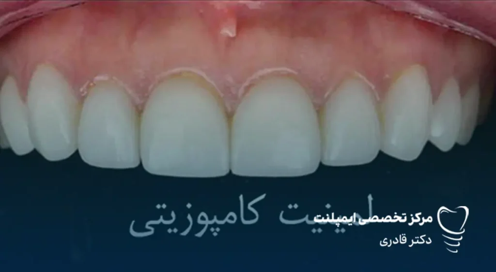 تفاوت بین لمینت سرامیکی و لمینت کامپوزیتی همه ما می‌دانیم که یکی از مهم‌ترین عوامل تاثیرگذار بر اعتماد به نفس افراد لبخند است و همه دوست دارند لبخندی زیبا داشته باشند. لمینت سرامیکی و کامپوزیتی دو گزینه محبوب برای دستیابی به لبخندی درخشان و بی‌نقص هستند. هر یک از این روش‌ها مزایا و کاربردهای خاص خود را دارند و انتخاب بین آن‌ها به عوامل مختلفی از جمله وضعیت دندان‌ها، بودجه و سلیقه فردی بستگی دارد. در این مقاله، به تفاوت بین لمینت سرامیکی و لمینت کامپوزیتی پرداخته و به شما کمک می‌کنیم تا بهترین تصمیم را برای داشتن لبخندی زیبا بگیرید. لمنیت سرامیکی چیست و چه مزایایی دارد؟ قبل از بررسی تفاوت بین لمینت سرامیکی و لمینت کامپوزیتی بهتر است هر کدام را به صورت جداگانه معرفی کنیم. لمینت سرامیکی یک پوشش نازک و ظریف از جنس سرامیک است که به سطح جلویی دندان‌ها چسبانده می‌شود تا ظاهر دندان‌ها زیباتر و مرتب‌تر به نظر برسد. این روکش معمولاً برای اصلاح مشکلاتی مثل تغییر رنگ دندان‌ها، ترک‌ها، شکستن‌های جزئی یا فاصله‌های بین دندان‌ها استفاده می‌شود. برای نصب لمینت سرامیکی، دندان‌ها به طور کمی تراشیده می‌شوند تا روکش به درستی روی دندان‌ها قرار بگیرد. این روش به دلیل استفاده از سرامیک، به دندان‌ها ظاهری طبیعی و مقاوم می‌دهد. مزایای لمینت سرامیکی: • ظاهر طبیعی و زیبا: به دلیل شفافیت و همرنگ بودن با دندان‌های طبیعی، ظاهر زیباتری نسبت به سایر روش‌ها دارد. • مقاومت بالا: لمینت سرامیکی بسیار مقاوم است و در برابر لکه‌ها و آسیب‌های خارجی مقاومت بیشتری دارد. • طول عمر طولانی: این نوع لمینت به طور معمول بیشتر از کامپوزیت‌ها عمر می‌کند. • اصلاح سریع مشکلات دندانی: می‌تواند به سرعت مشکلاتی مانند تغییر رنگ، ترک‌ها و بی‌نظمی‌های جزئی دندان‌ها را برطرف کند. • حساسیت کمتر: به دلیل تراش کمتری که از دندان‌ها گرفته می‌شود، معمولاً حسایت کمتری نسبت به روش‌های دیگر ایجاد می‌کند.