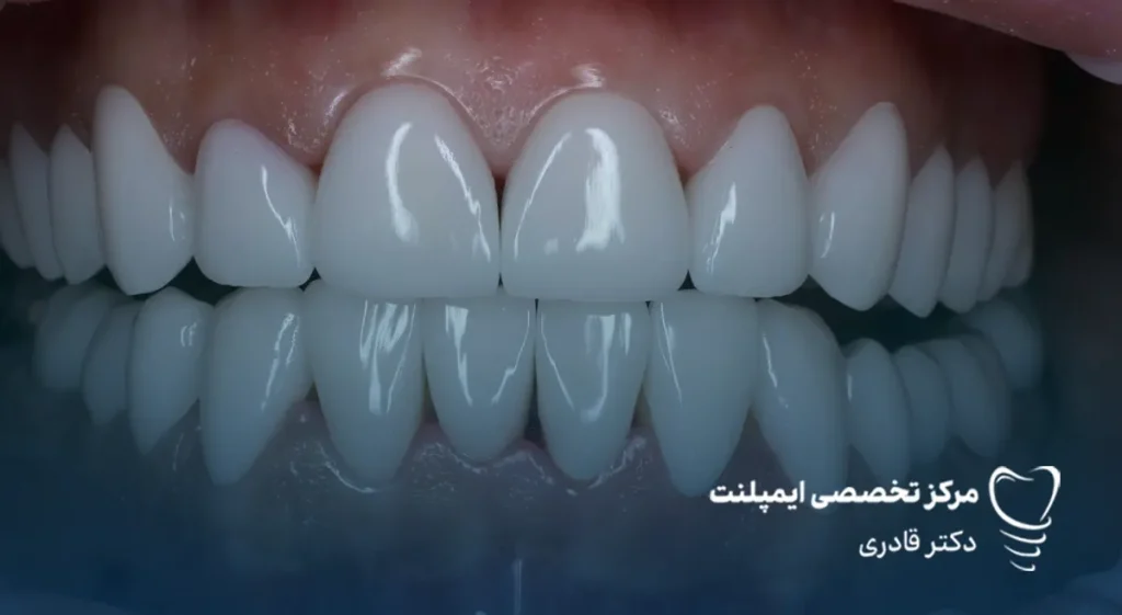 تفاوت بین لمینت سرامیکی و لمینت کامپوزیتی همه ما می‌دانیم که یکی از مهم‌ترین عوامل تاثیرگذار بر اعتماد به نفس افراد لبخند است و همه دوست دارند لبخندی زیبا داشته باشند. لمینت سرامیکی و کامپوزیتی دو گزینه محبوب برای دستیابی به لبخندی درخشان و بی‌نقص هستند. هر یک از این روش‌ها مزایا و کاربردهای خاص خود را دارند و انتخاب بین آن‌ها به عوامل مختلفی از جمله وضعیت دندان‌ها، بودجه و سلیقه فردی بستگی دارد. در این مقاله، به تفاوت بین لمینت سرامیکی و لمینت کامپوزیتی پرداخته و به شما کمک می‌کنیم تا بهترین تصمیم را برای داشتن لبخندی زیبا بگیرید. لمنیت سرامیکی چیست و چه مزایایی دارد؟ قبل از بررسی تفاوت بین لمینت سرامیکی و لمینت کامپوزیتی بهتر است هر کدام را به صورت جداگانه معرفی کنیم. لمینت سرامیکی یک پوشش نازک و ظریف از جنس سرامیک است که به سطح جلویی دندان‌ها چسبانده می‌شود تا ظاهر دندان‌ها زیباتر و مرتب‌تر به نظر برسد. این روکش معمولاً برای اصلاح مشکلاتی مثل تغییر رنگ دندان‌ها، ترک‌ها، شکستن‌های جزئی یا فاصله‌های بین دندان‌ها استفاده می‌شود. برای نصب لمینت سرامیکی، دندان‌ها به طور کمی تراشیده می‌شوند تا روکش به درستی روی دندان‌ها قرار بگیرد. این روش به دلیل استفاده از سرامیک، به دندان‌ها ظاهری طبیعی و مقاوم می‌دهد. مزایای لمینت سرامیکی: • ظاهر طبیعی و زیبا: به دلیل شفافیت و همرنگ بودن با دندان‌های طبیعی، ظاهر زیباتری نسبت به سایر روش‌ها دارد. • مقاومت بالا: لمینت سرامیکی بسیار مقاوم است و در برابر لکه‌ها و آسیب‌های خارجی مقاومت بیشتری دارد. • طول عمر طولانی: این نوع لمینت به طور معمول بیشتر از کامپوزیت‌ها عمر می‌کند. • اصلاح سریع مشکلات دندانی: می‌تواند به سرعت مشکلاتی مانند تغییر رنگ، ترک‌ها و بی‌نظمی‌های جزئی دندان‌ها را برطرف کند. • حساسیت کمتر: به دلیل تراش کمتری که از دندان‌ها گرفته می‌شود، معمولاً حسایت کمتری نسبت به روش‌های دیگر ایجاد می‌کند.