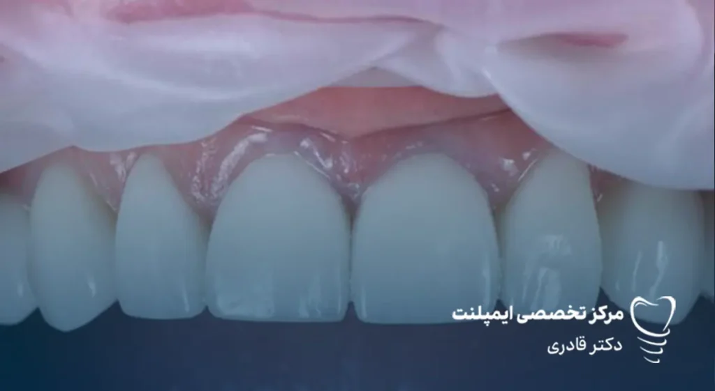 تفاوت بین لمینت سرامیکی و لمینت کامپوزیتی همه ما می‌دانیم که یکی از مهم‌ترین عوامل تاثیرگذار بر اعتماد به نفس افراد لبخند است و همه دوست دارند لبخندی زیبا داشته باشند. لمینت سرامیکی و کامپوزیتی دو گزینه محبوب برای دستیابی به لبخندی درخشان و بی‌نقص هستند. هر یک از این روش‌ها مزایا و کاربردهای خاص خود را دارند و انتخاب بین آن‌ها به عوامل مختلفی از جمله وضعیت دندان‌ها، بودجه و سلیقه فردی بستگی دارد. در این مقاله، به تفاوت بین لمینت سرامیکی و لمینت کامپوزیتی پرداخته و به شما کمک می‌کنیم تا بهترین تصمیم را برای داشتن لبخندی زیبا بگیرید. لمنیت سرامیکی چیست و چه مزایایی دارد؟ قبل از بررسی تفاوت بین لمینت سرامیکی و لمینت کامپوزیتی بهتر است هر کدام را به صورت جداگانه معرفی کنیم. لمینت سرامیکی یک پوشش نازک و ظریف از جنس سرامیک است که به سطح جلویی دندان‌ها چسبانده می‌شود تا ظاهر دندان‌ها زیباتر و مرتب‌تر به نظر برسد. این روکش معمولاً برای اصلاح مشکلاتی مثل تغییر رنگ دندان‌ها، ترک‌ها، شکستن‌های جزئی یا فاصله‌های بین دندان‌ها استفاده می‌شود. برای نصب لمینت سرامیکی، دندان‌ها به طور کمی تراشیده می‌شوند تا روکش به درستی روی دندان‌ها قرار بگیرد. این روش به دلیل استفاده از سرامیک، به دندان‌ها ظاهری طبیعی و مقاوم می‌دهد. مزایای لمینت سرامیکی: • ظاهر طبیعی و زیبا: به دلیل شفافیت و همرنگ بودن با دندان‌های طبیعی، ظاهر زیباتری نسبت به سایر روش‌ها دارد. • مقاومت بالا: لمینت سرامیکی بسیار مقاوم است و در برابر لکه‌ها و آسیب‌های خارجی مقاومت بیشتری دارد. • طول عمر طولانی: این نوع لمینت به طور معمول بیشتر از کامپوزیت‌ها عمر می‌کند. • اصلاح سریع مشکلات دندانی: می‌تواند به سرعت مشکلاتی مانند تغییر رنگ، ترک‌ها و بی‌نظمی‌های جزئی دندان‌ها را برطرف کند. • حساسیت کمتر: به دلیل تراش کمتری که از دندان‌ها گرفته می‌شود، معمولاً حسایت کمتری نسبت به روش‌های دیگر ایجاد می‌کند.