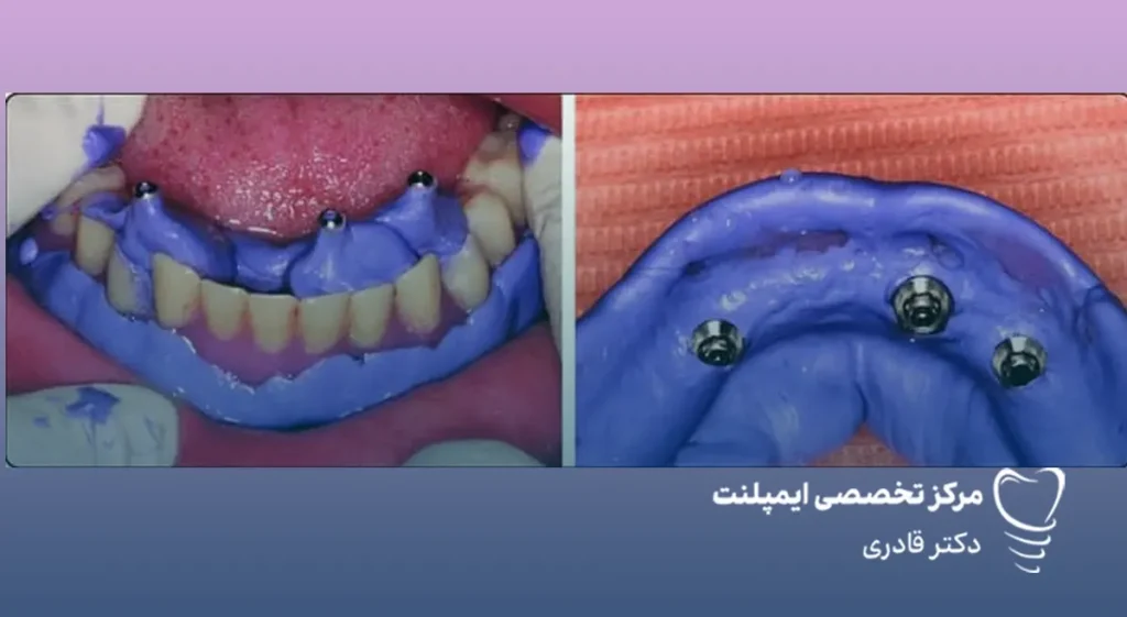 قالب‌ گیری ایمپلنت دندان