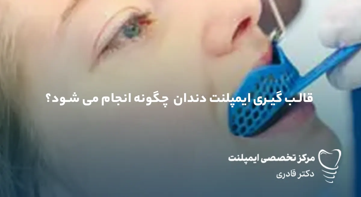 قالب‌ گیری ایمپلنت دندان