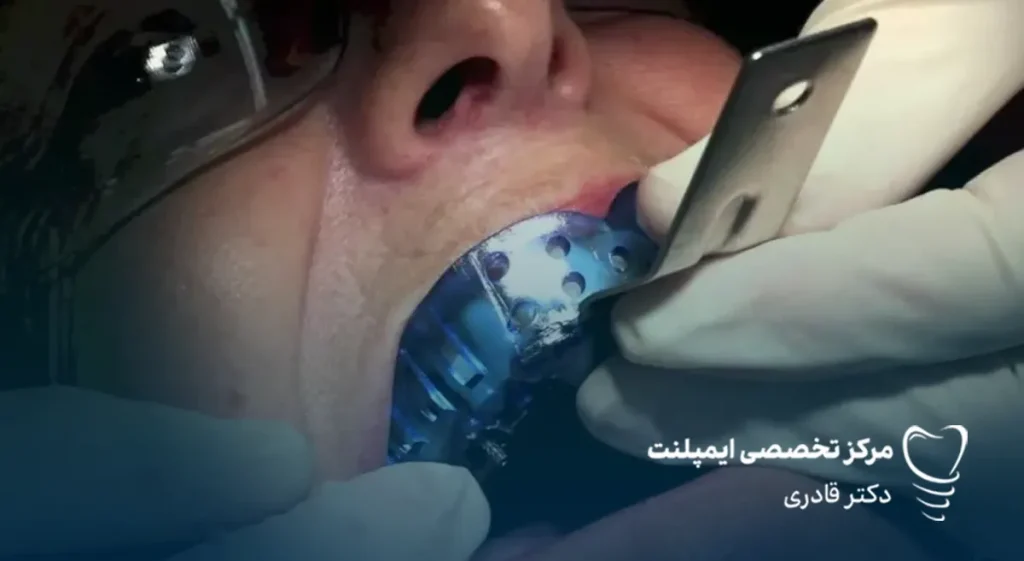 قالب‌ گیری ایمپلنت دندان