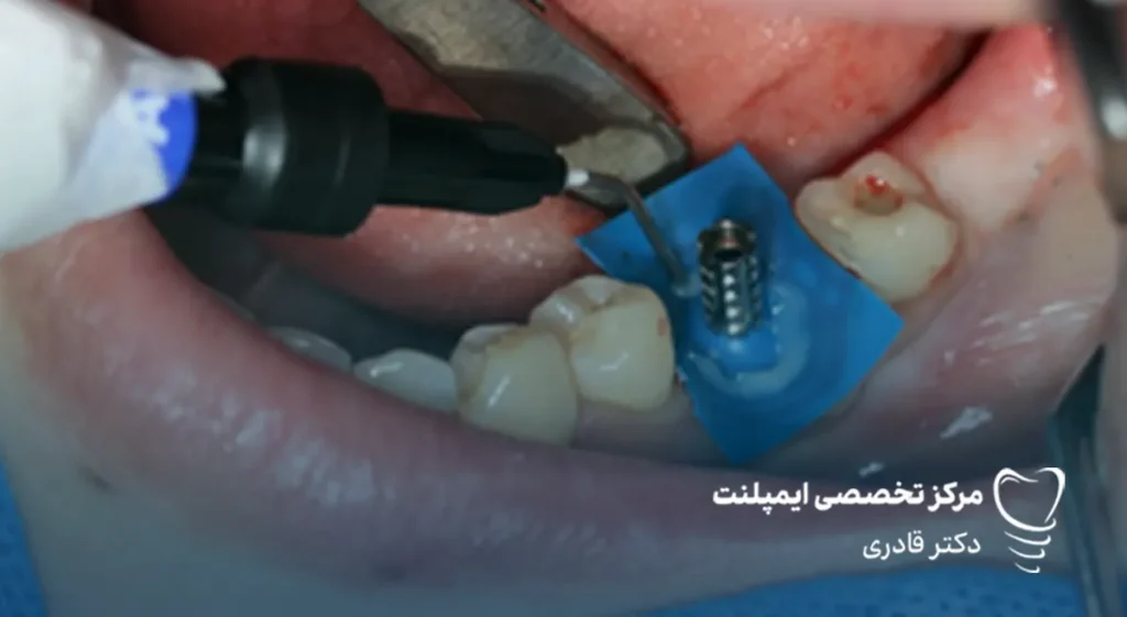قالب‌ گیری ایمپلنت دندان