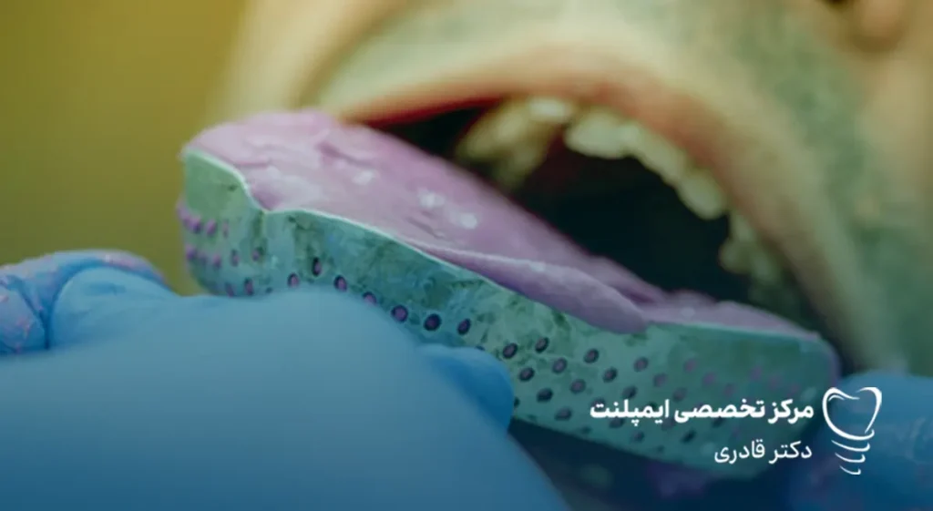 قالب‌ گیری ایمپلنت دندان