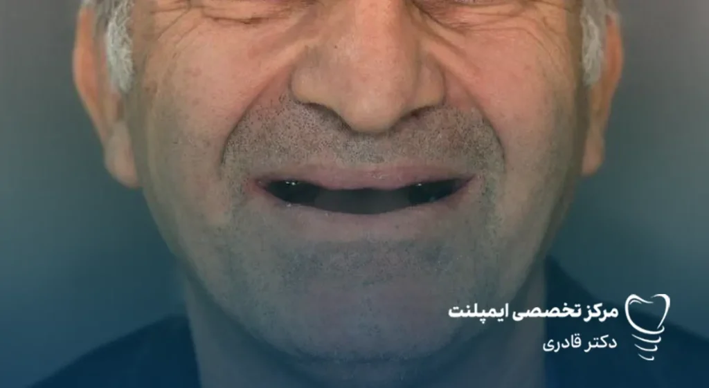 قیمت انواع ایمپلنت