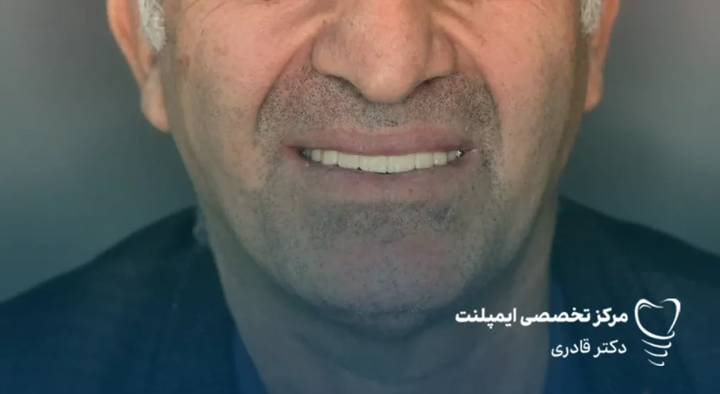قیمت ایمپلنت کل فک