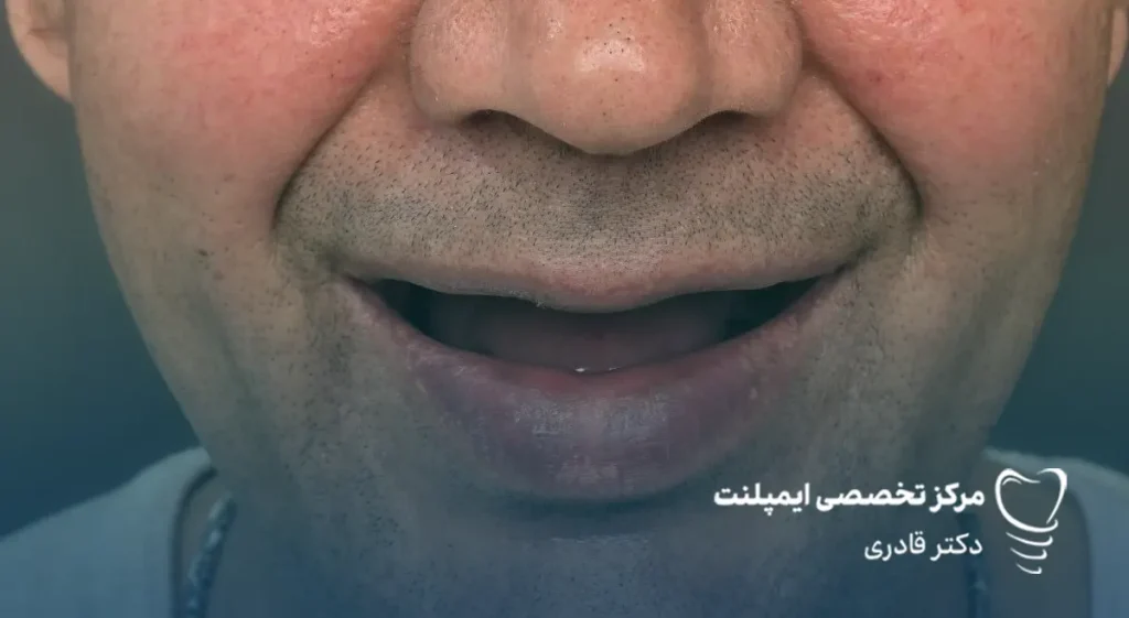 قیمت کاشت دندان - قیمت دندان ایمپلنت