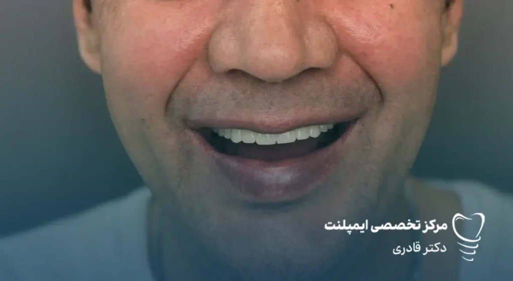 قیمت انواع ایمپلنت قیمت هر واحد ایمپلنت دندان هزینه ایمپلنت