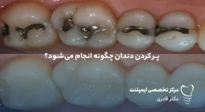 پر کردن دندان