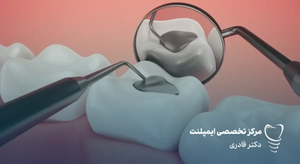 پر کردن دندان