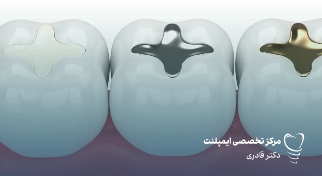 پر کردن دندان