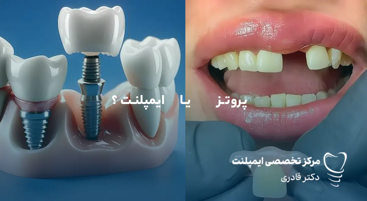 پروتز دندان یا ایمپلنت ؟