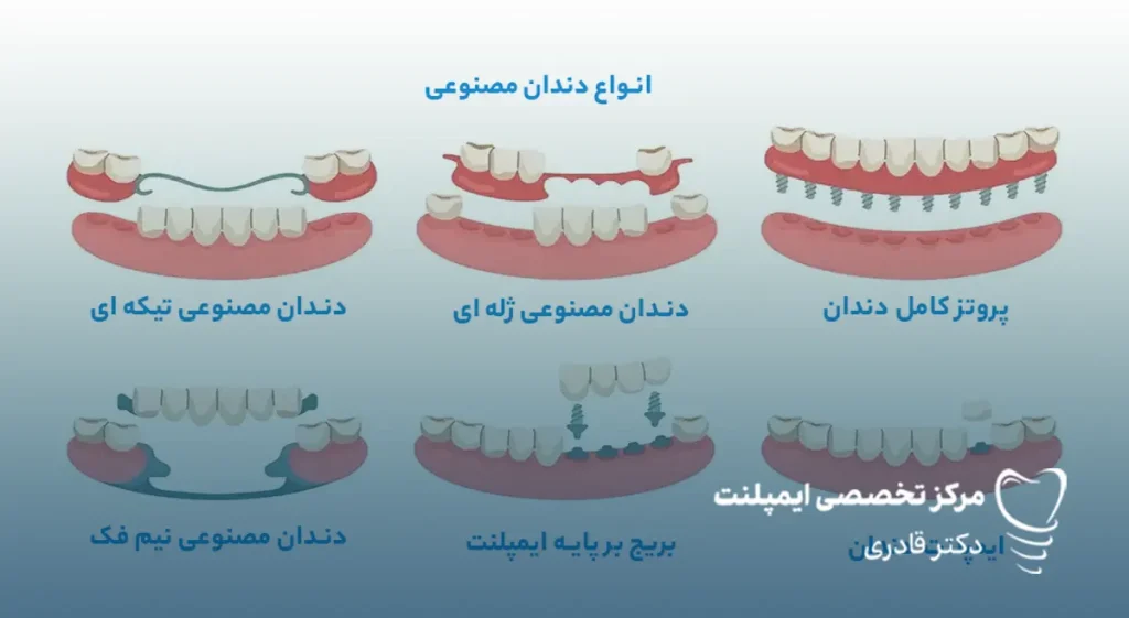 انواع دندان مصنوعی