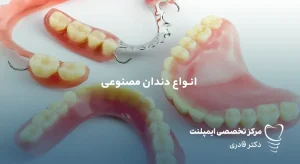 انواع دندان مصنوعی