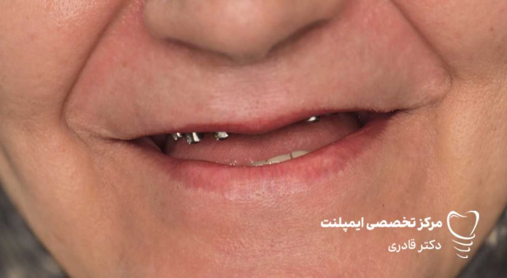 عکس نمونه کار قبل و بعد ایمپلنت