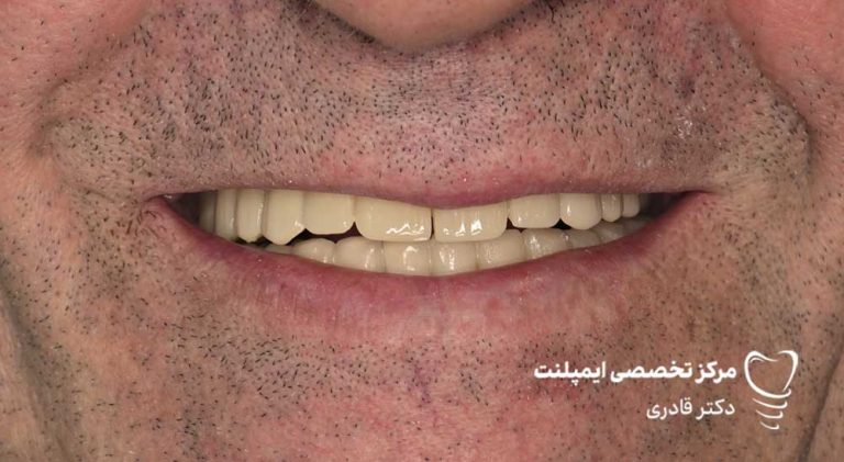 عکس نمونه کار قبل و بعد ایمپلنت
