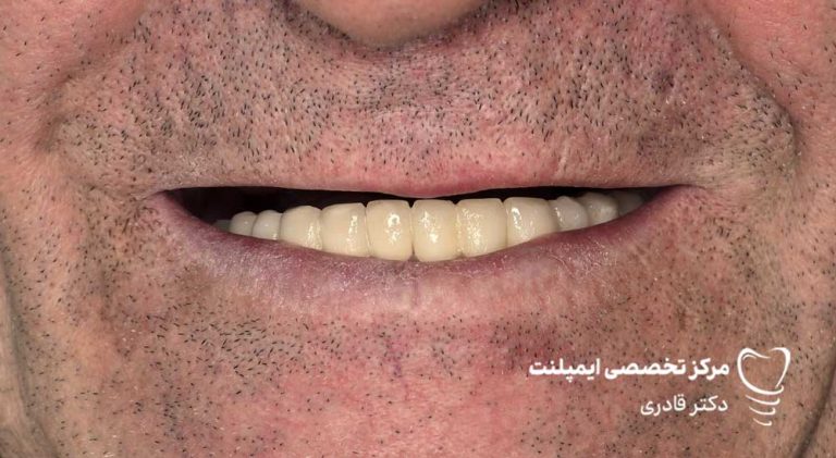 عکس نمونه کار قبل و بعد ایمپلنت