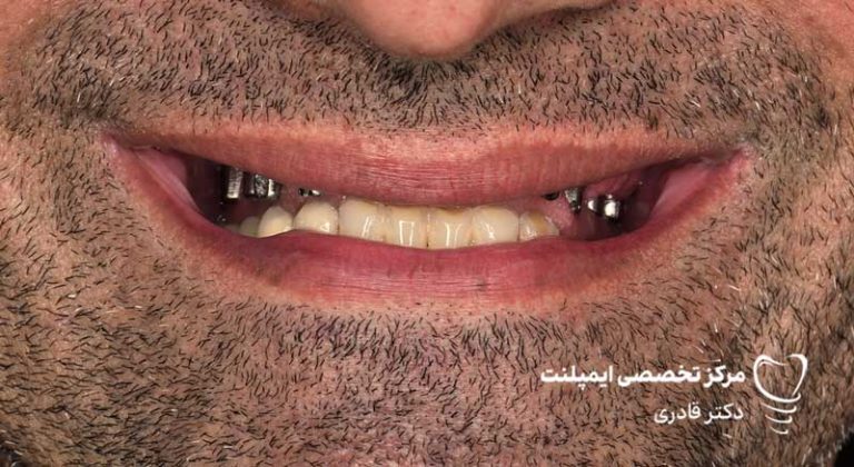 عکس نمونه کار قبل و بعد ایمپلنت