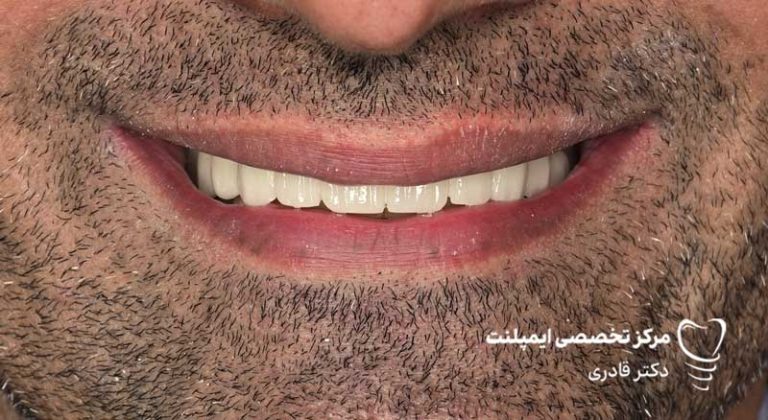 عکس نمونه کار قبل و بعد ایمپلنت
