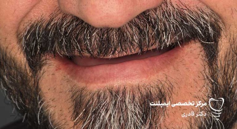 عکس نمونه کار قبل و بعد ایمپلنت