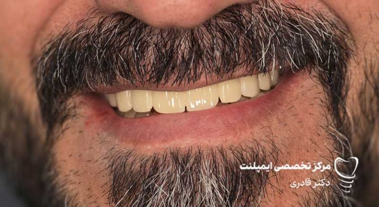 عکس نمونه کار قبل و بعد ایمپلنت