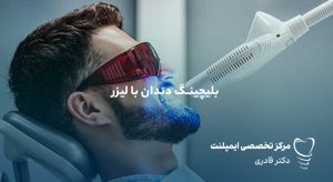بلیچینگ دندان با لیزر