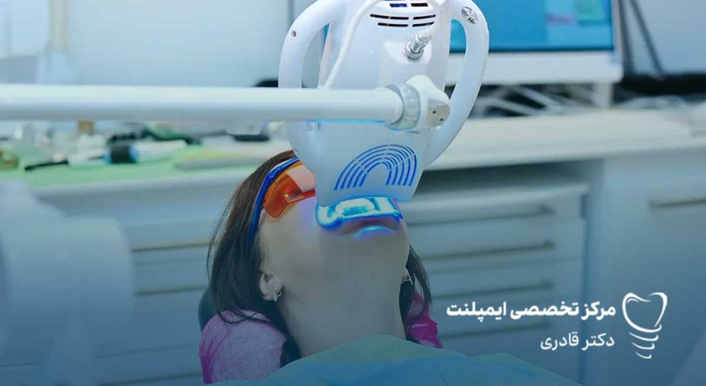 بلیچینگ دندان با لیزر