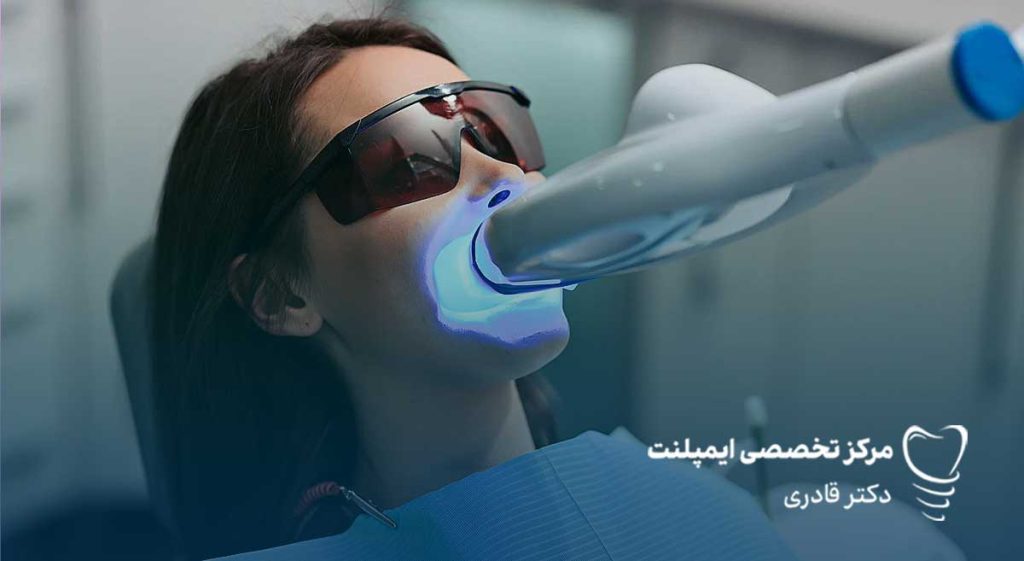 بلیچینگ دندان با لیزر