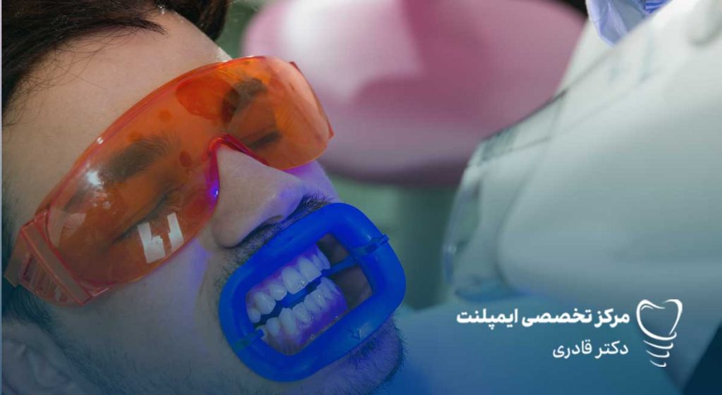 بلیچینگ دندان با لیزر