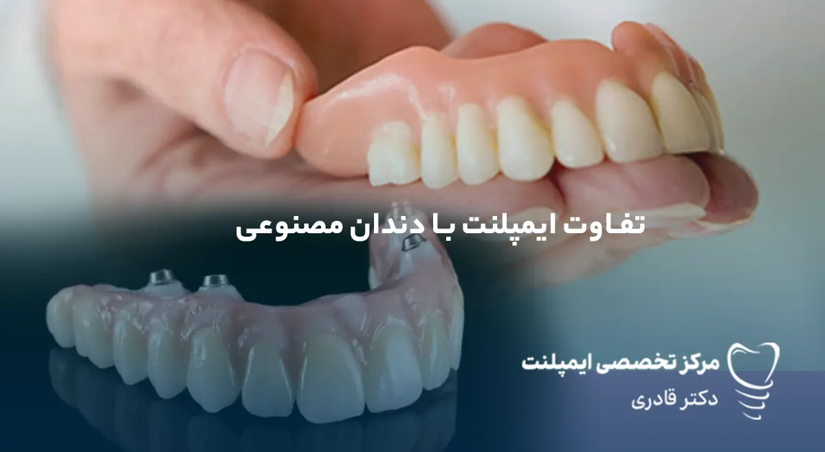 تفاوت دندان مصنوعی با ایمپلنت