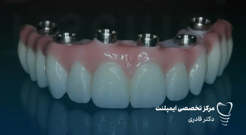 تفاوت دندان مصنوعی با ایمپلنت