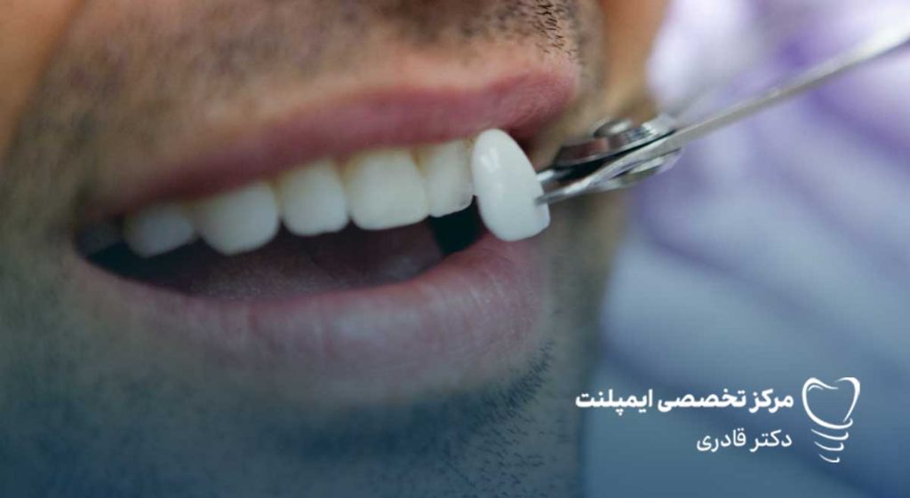 آیا لمینت دندان درد دارد؟