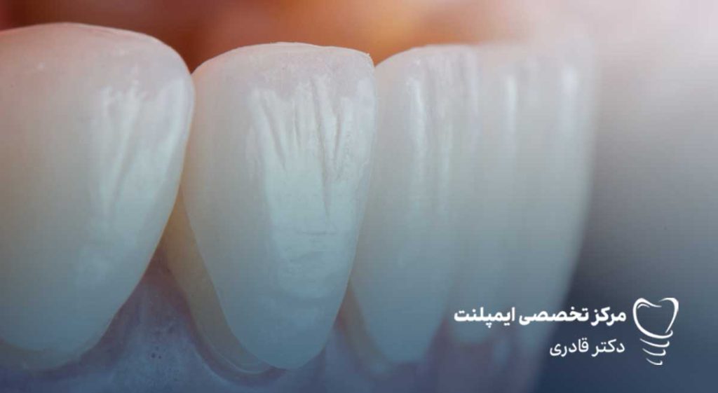 آیا لمینت دندان درد دارد؟