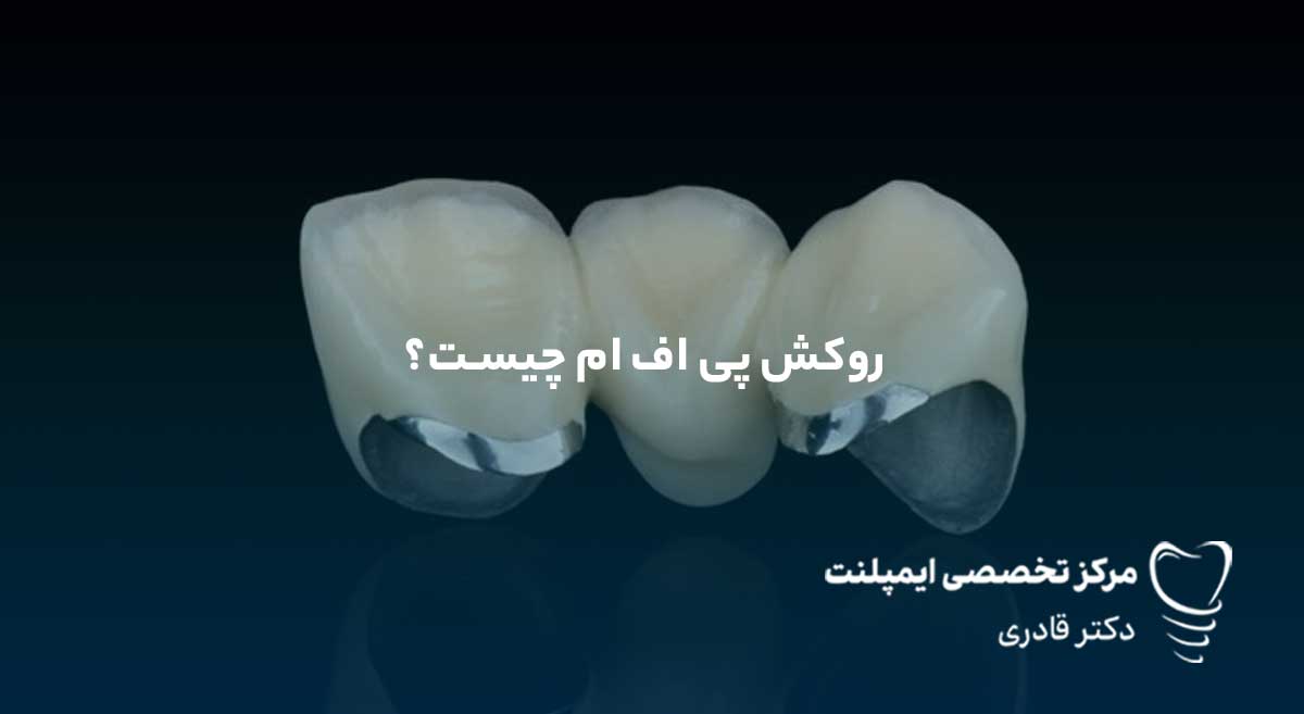 روکش پی اف ام چیست؟