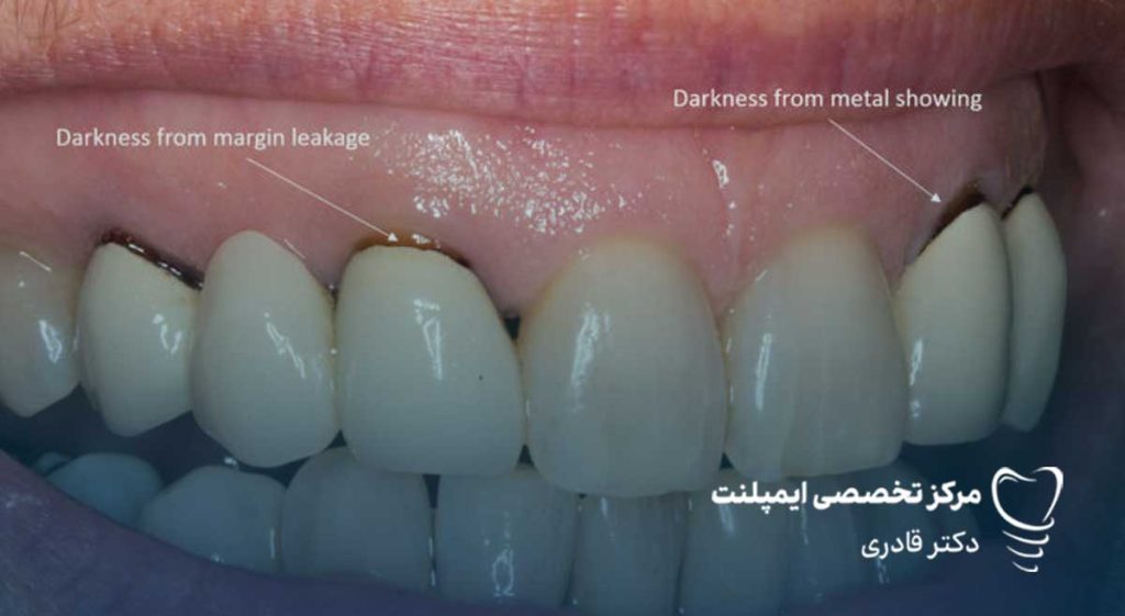 روکش پی اف ام.jpg1