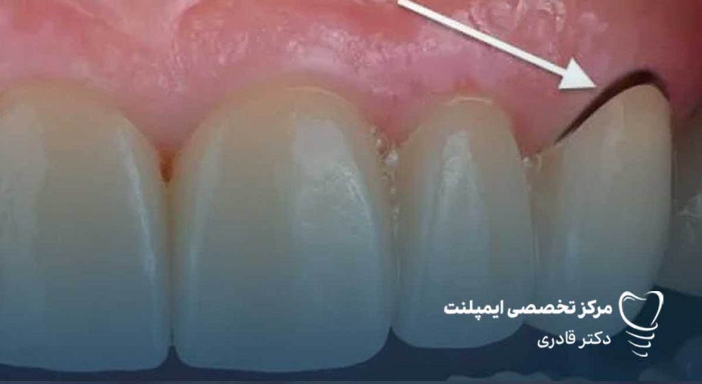 روکش پی اف ام4