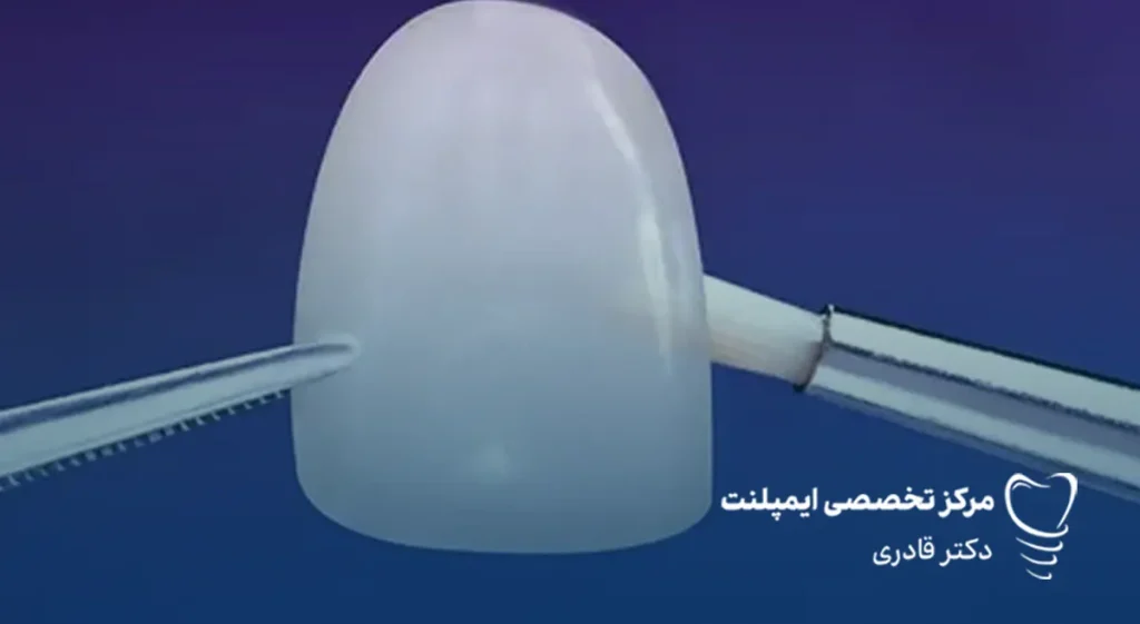 لمینت دندان چقدر طول می‌کشد؟