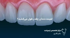 لمینت دندان چقدر طول می‌کشد؟