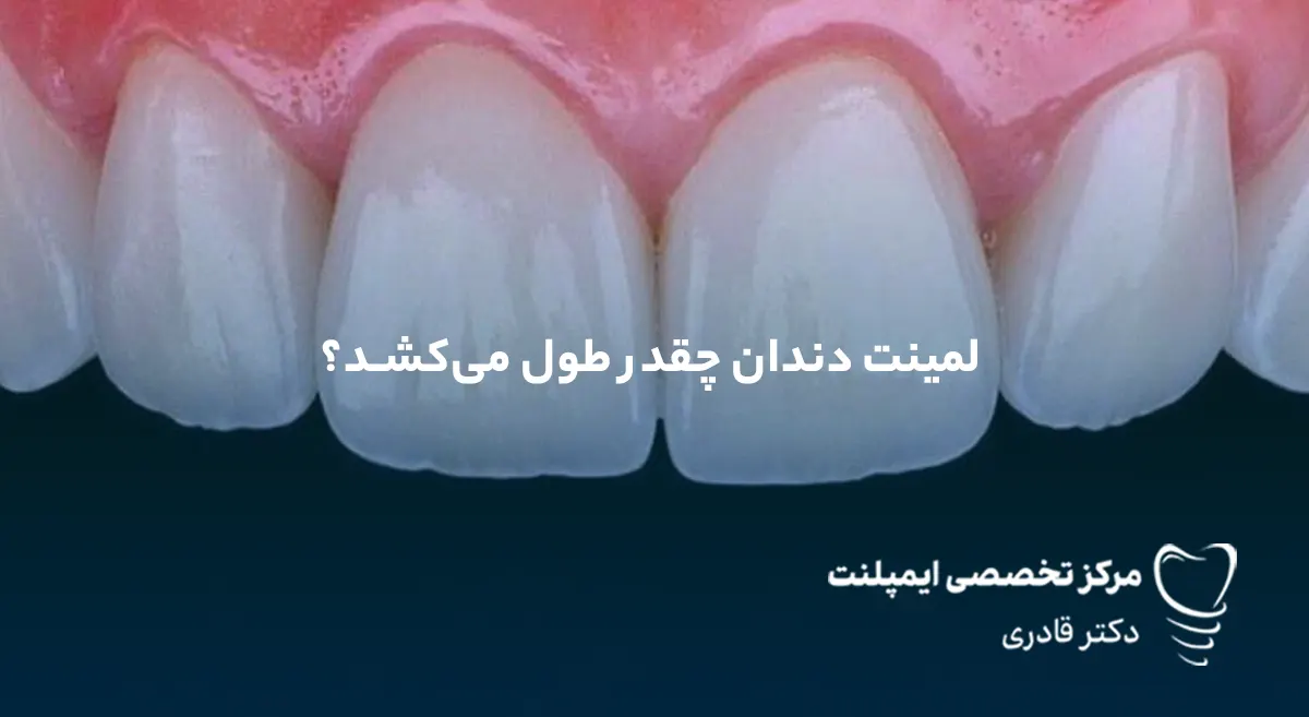 لمینت دندان چقدر طول می‌کشد؟