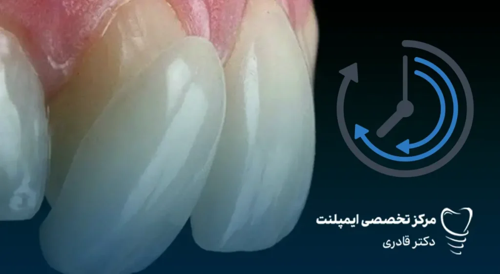 لمینت دندان چقدر طول می‌کشد؟