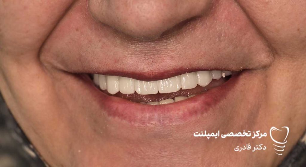 عکس نمونه کار قبل و بعد ایمپلنت